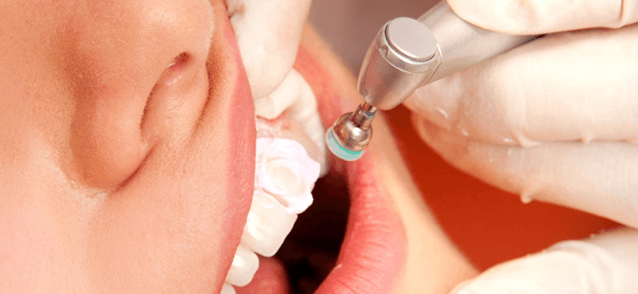Чистка зубов перед имплантацией зубов